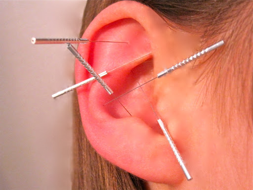 NADA Ear Acupuncture for Stress Relief and Withdrawal Symptoms